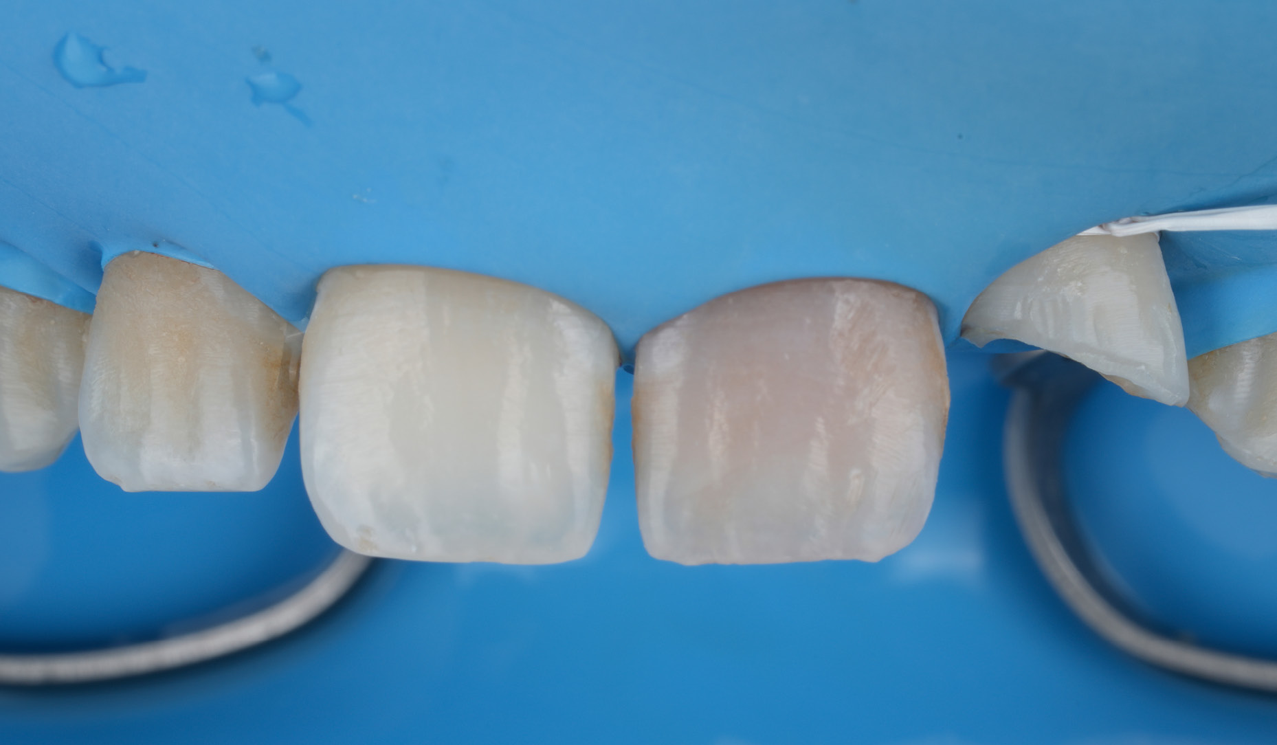 Restoring A Complicated Crown Fracture: A Step-By-Step Guide to Polychromatic Layering